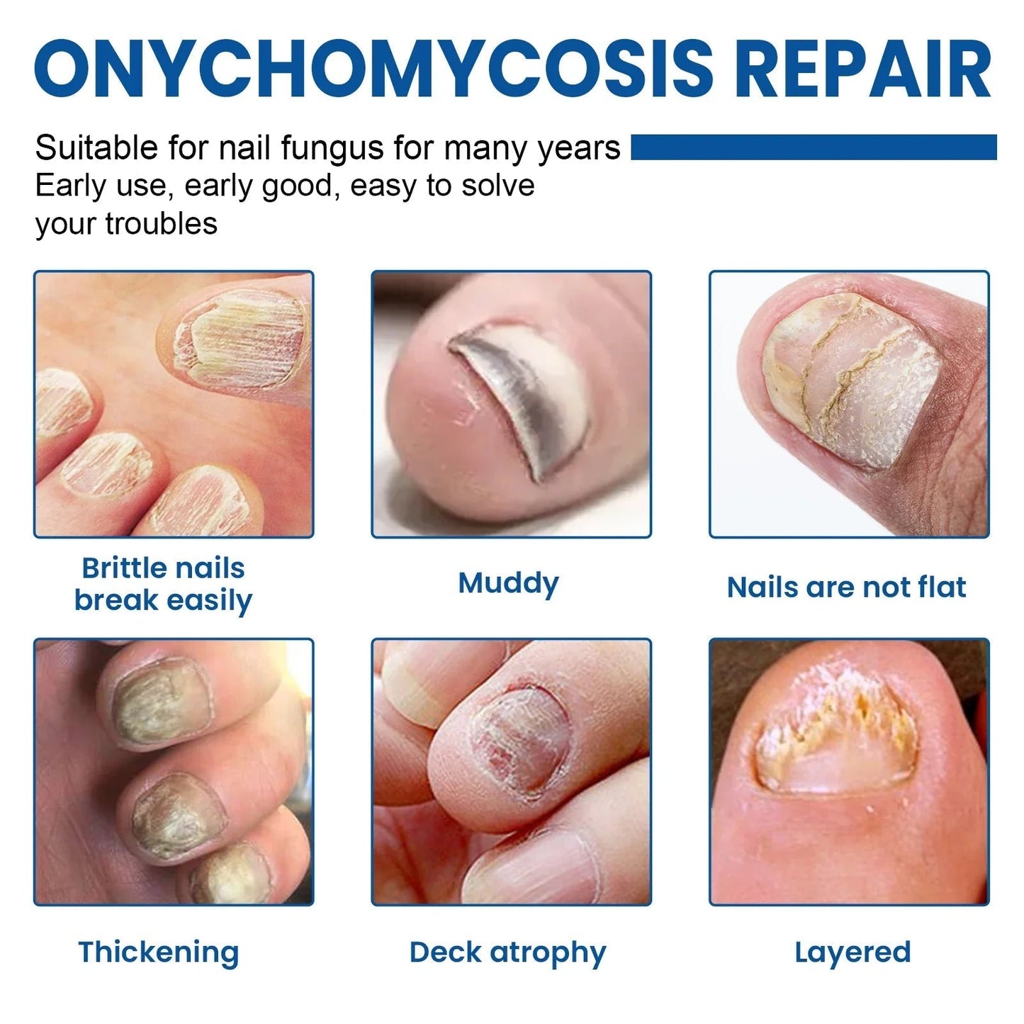 🔥 Last Day 50% OFF CURALONA® Nail Fungus Care Patches 🩹 From Yellow, Brittle-Looking Nails to Clearer, Healthier-Looking Nails