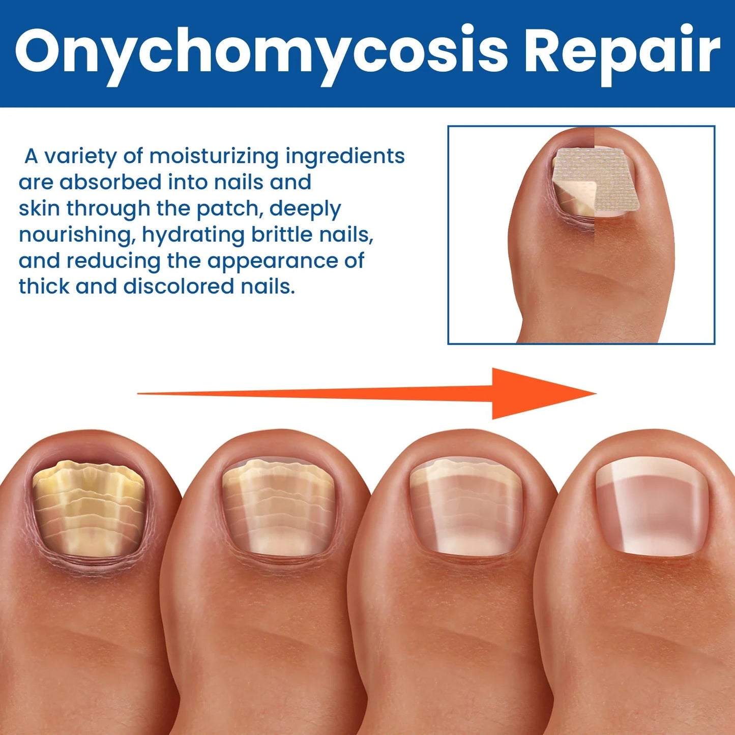 🔥 Last Day 50% OFF CURALONA® Nail Fungus Care Patches 🩹 From Yellow, Brittle-Looking Nails to Clearer, Healthier-Looking Nails