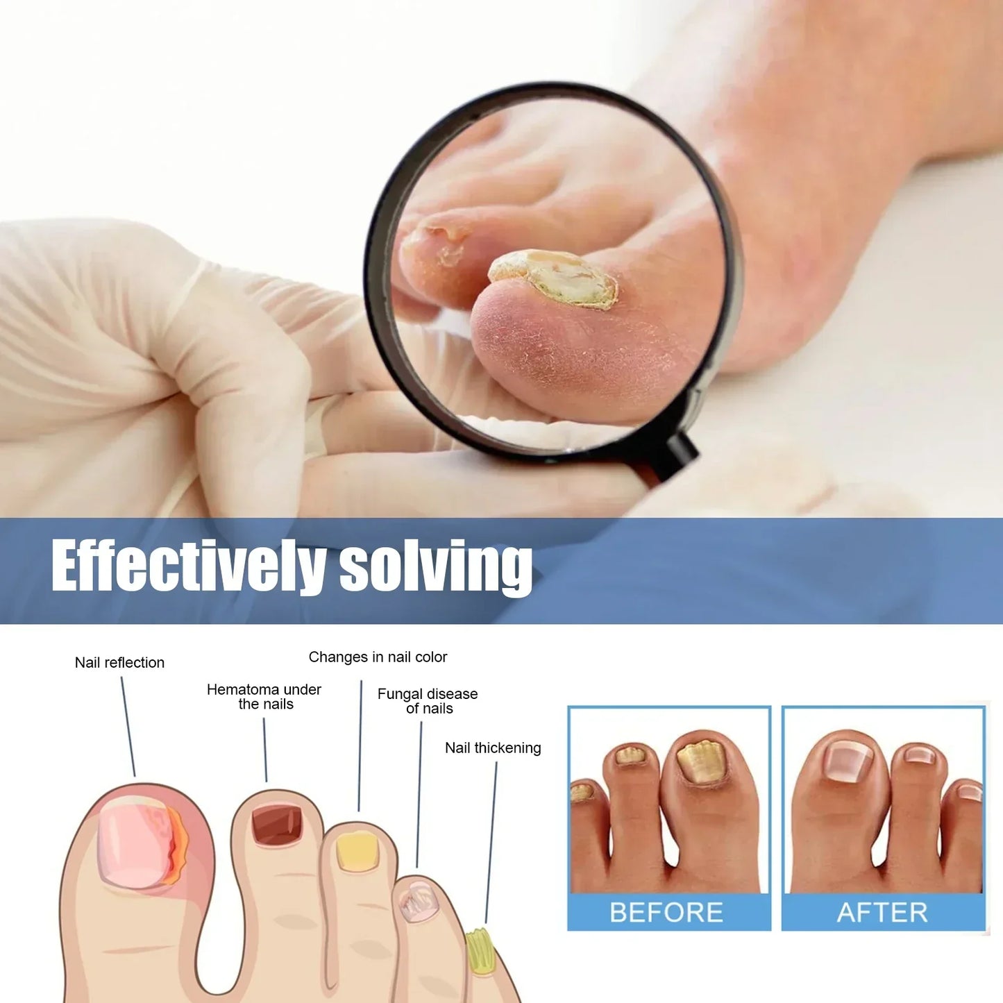 🔥 Last Day 50% OFF CURALONA® Nail Fungus Care Patches 🩹 From Yellow, Brittle-Looking Nails to Clearer, Healthier-Looking Nails