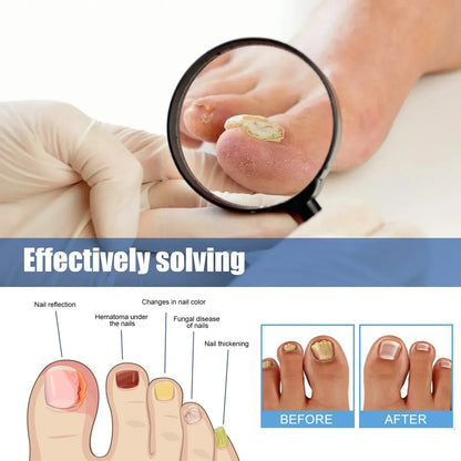 🔥 Last Day 50% OFF CURALONA® Nail Fungus Care Patches 🩹 From Yellow, Brittle-Looking Nails to Clearer, Healthier-Looking Nails